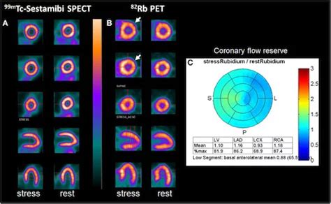 is nuclear stress test hard on kidneys|nuclear stress test results.